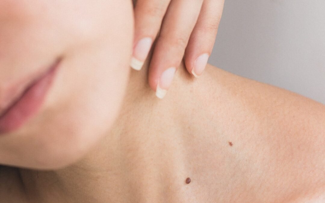 Transform Your Skin with Morpheus8: Acne Scarring and Texture Improvement at Beech House Dental in Cobham, Surrey