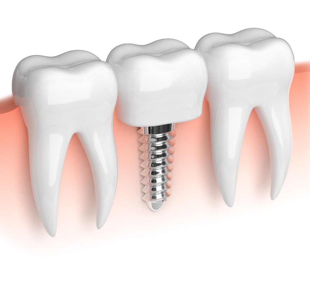 dental implant